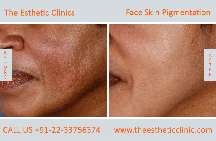 Face Skin Pigmentation Laser Treatment before after photos in mumbai india (3)